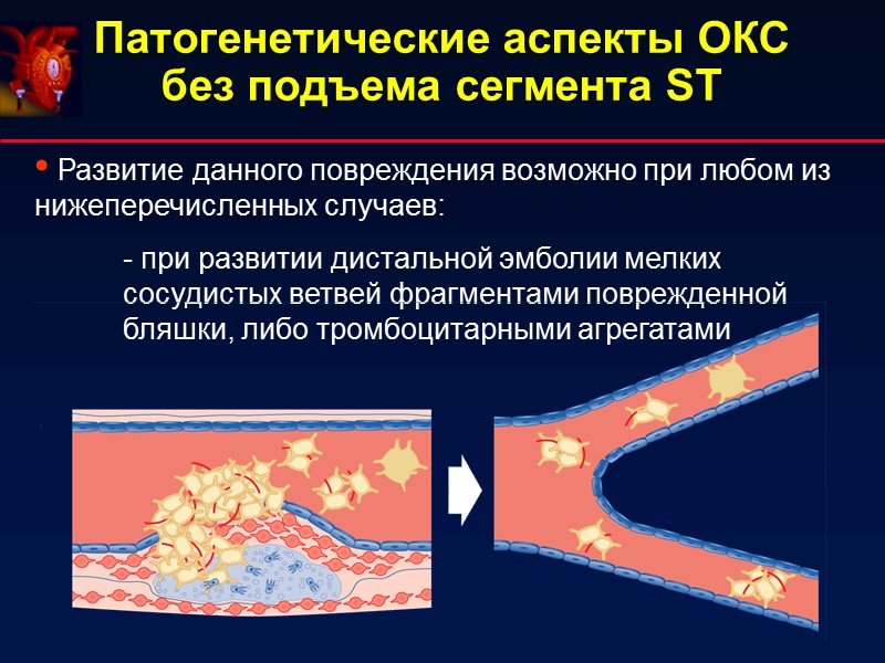 Патогенетические аспекты ОКС без подъема сегмента ST Развитие данного повреждения возможно Патогенетические аспекты ОКС без подъема сегмента ST Развитие данного повреждения возможно